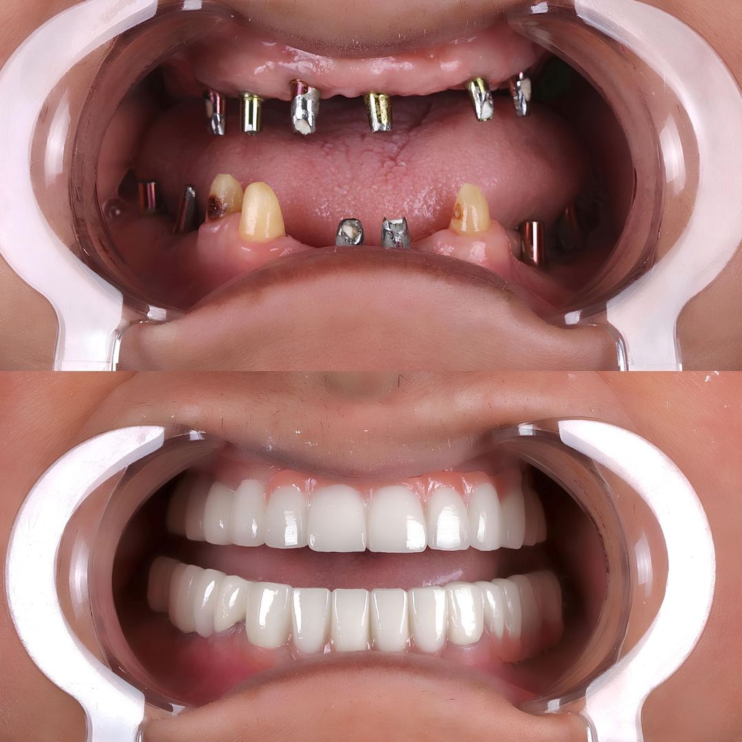 All-on-4 Dental Implants